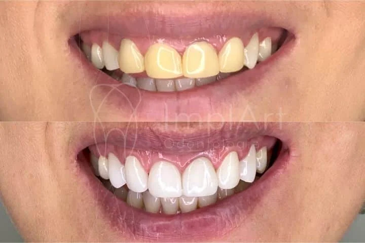 Clareamento dental