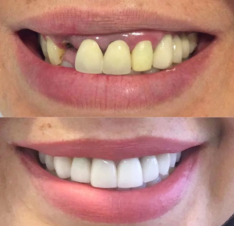 Implante dentário